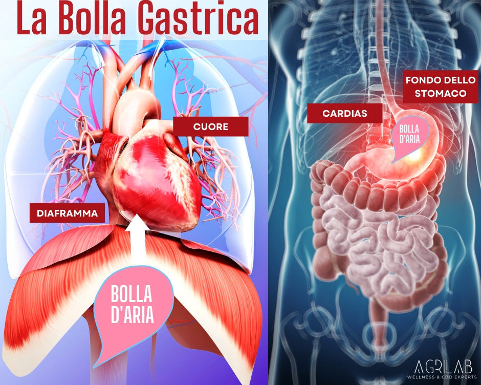 Bolla gastrica e reflusso gastroeofageo