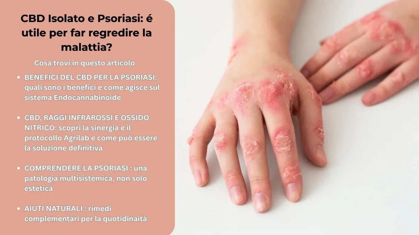 cbd e psoriasi : é utile per far regredire la malattia?