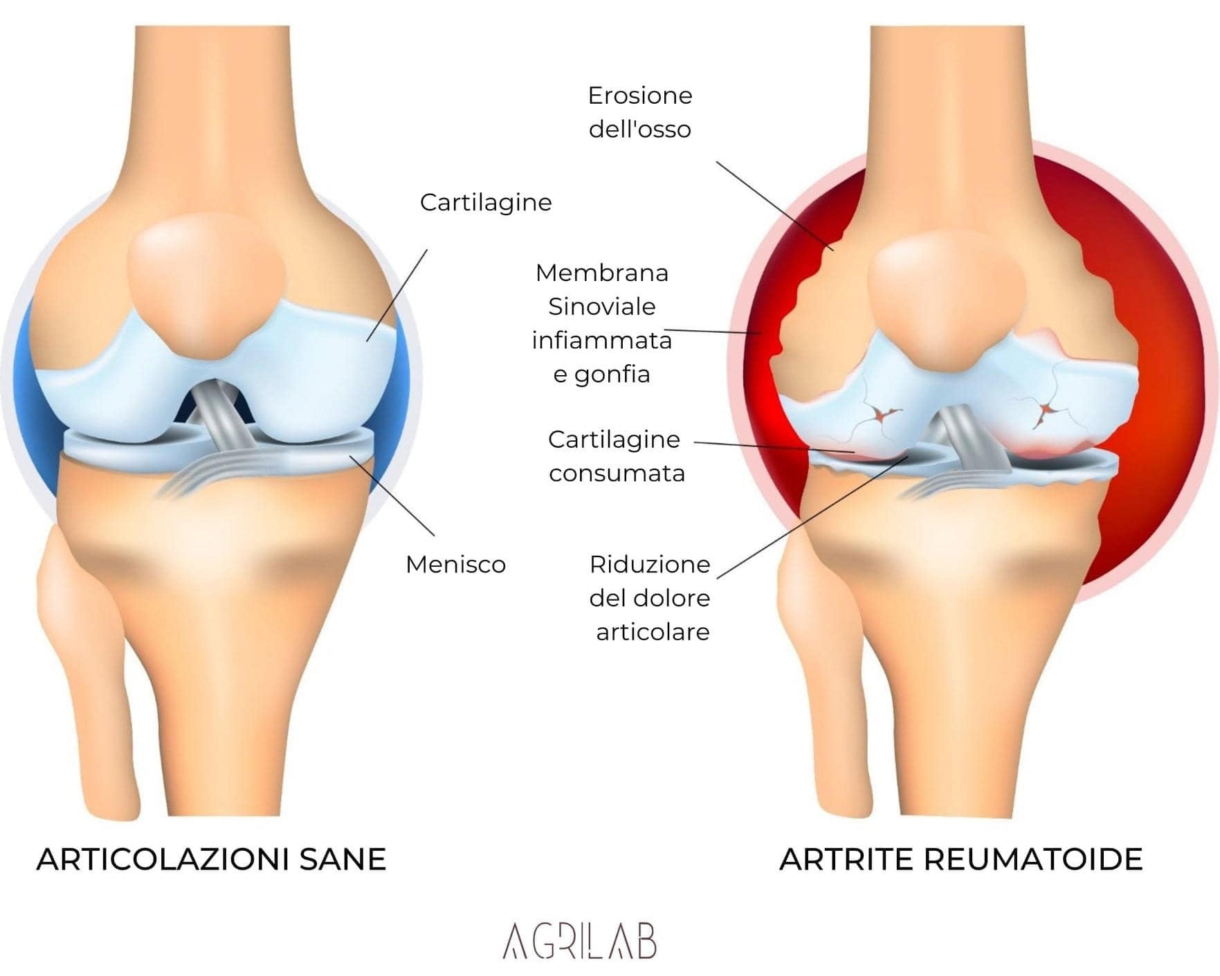 cbd isolato e artrite reumatoide
