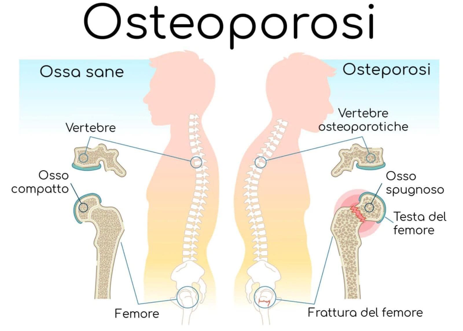 cbd isolato e cura dell'osteoporosi