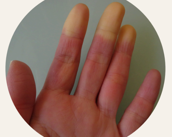 cbd isolato e cura della sclerodermia